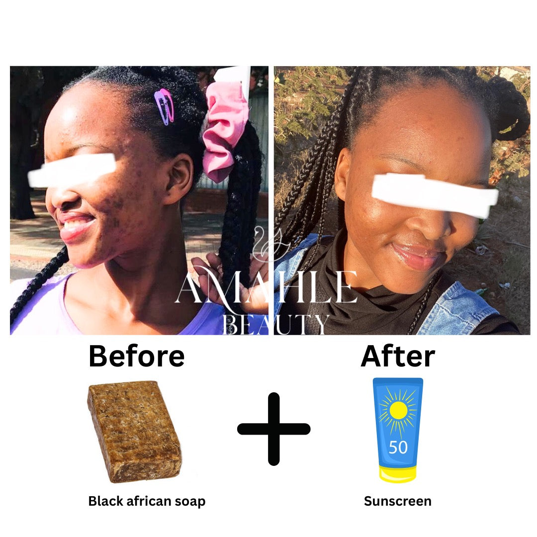 Black African soap (acne, dark spots, pigmentation & oily skin)