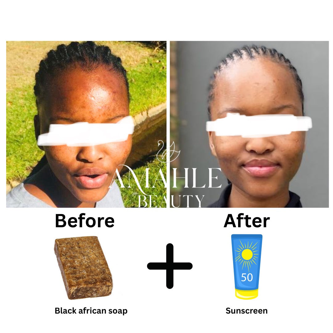 Black African soap (acne, dark spots, pigmentation & oily skin)